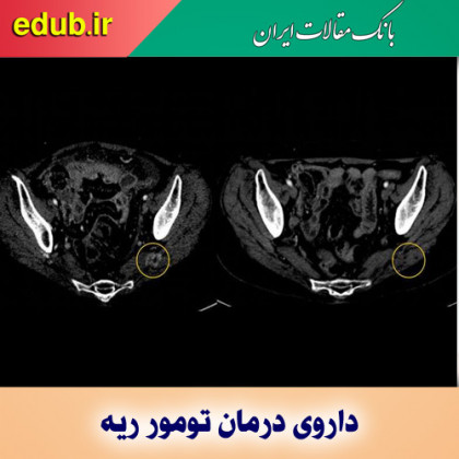 تایید یک داروی جدید برای درمان سرطان ریه ناشی از جهش ژنتیکی