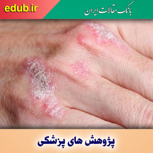 شناسایی عامل موثر در بروز بیماری پسوریازیس