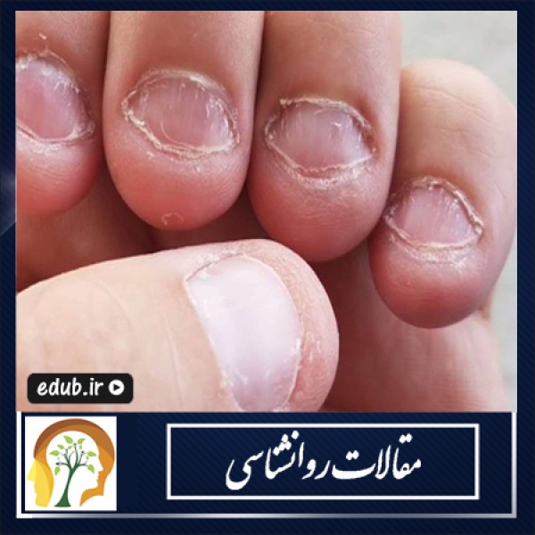 آیا ناخن جویدن نگران کننده است؟