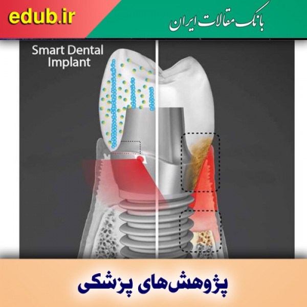 ایمپلنت هوشمند مانع رشد باکتری روی دندان‌ها می‌شود