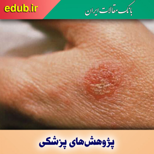 شناسایی داروی جدید برای درمان اگزما