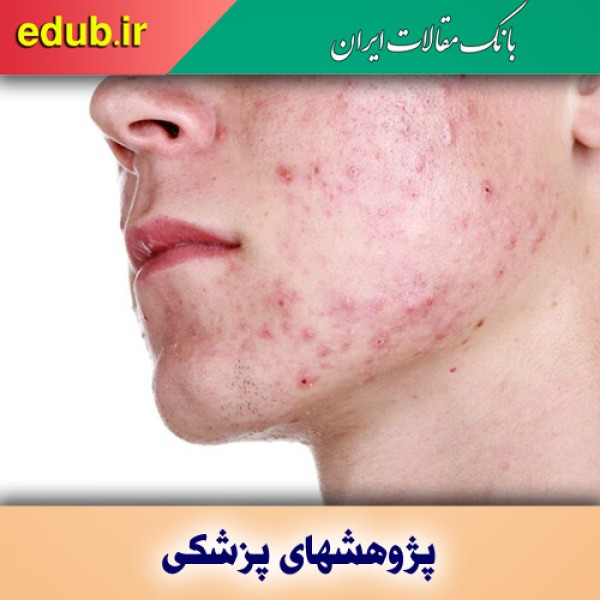 شناسایی ۲۹ ژن عامل آکنه