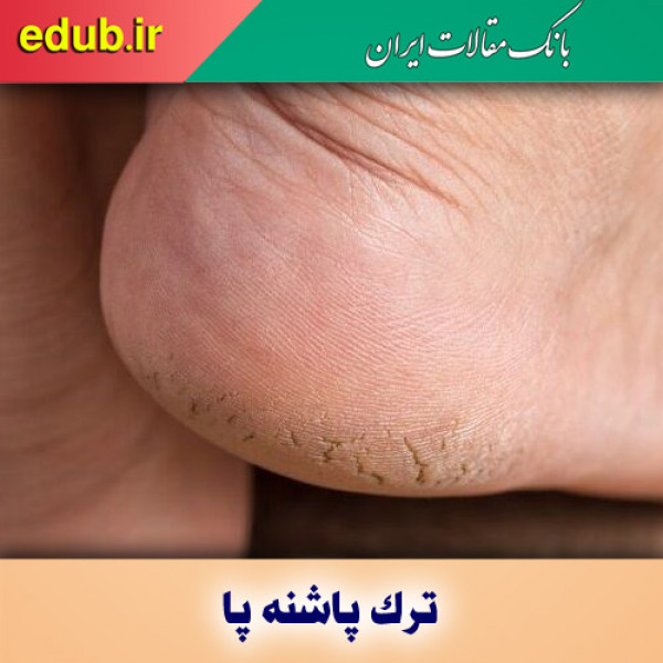 ۶ دلیلی که ترک پاشنه پا را توجیه می‌کند!